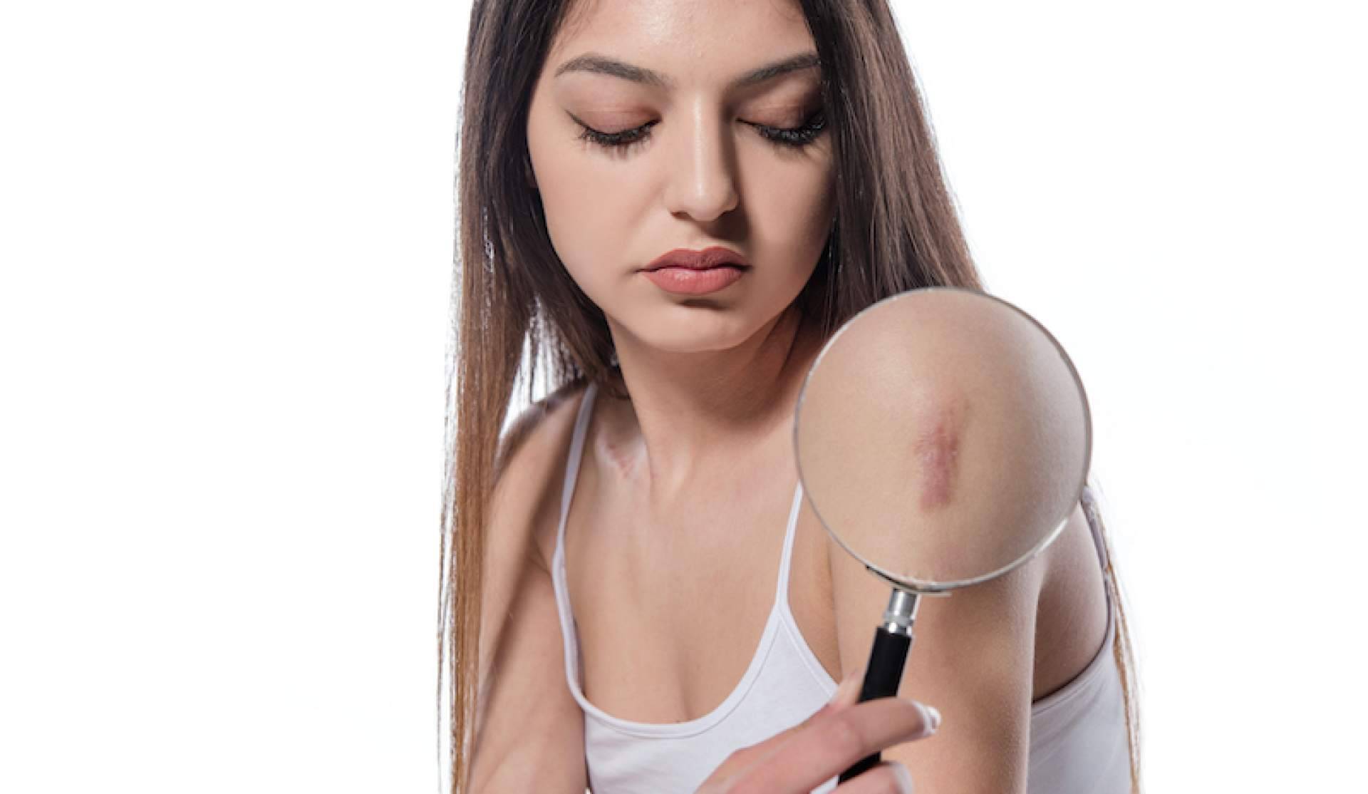 Las ventajas de usar tratamientos para eliminar cicatrices, con Centro Estética el Pilar