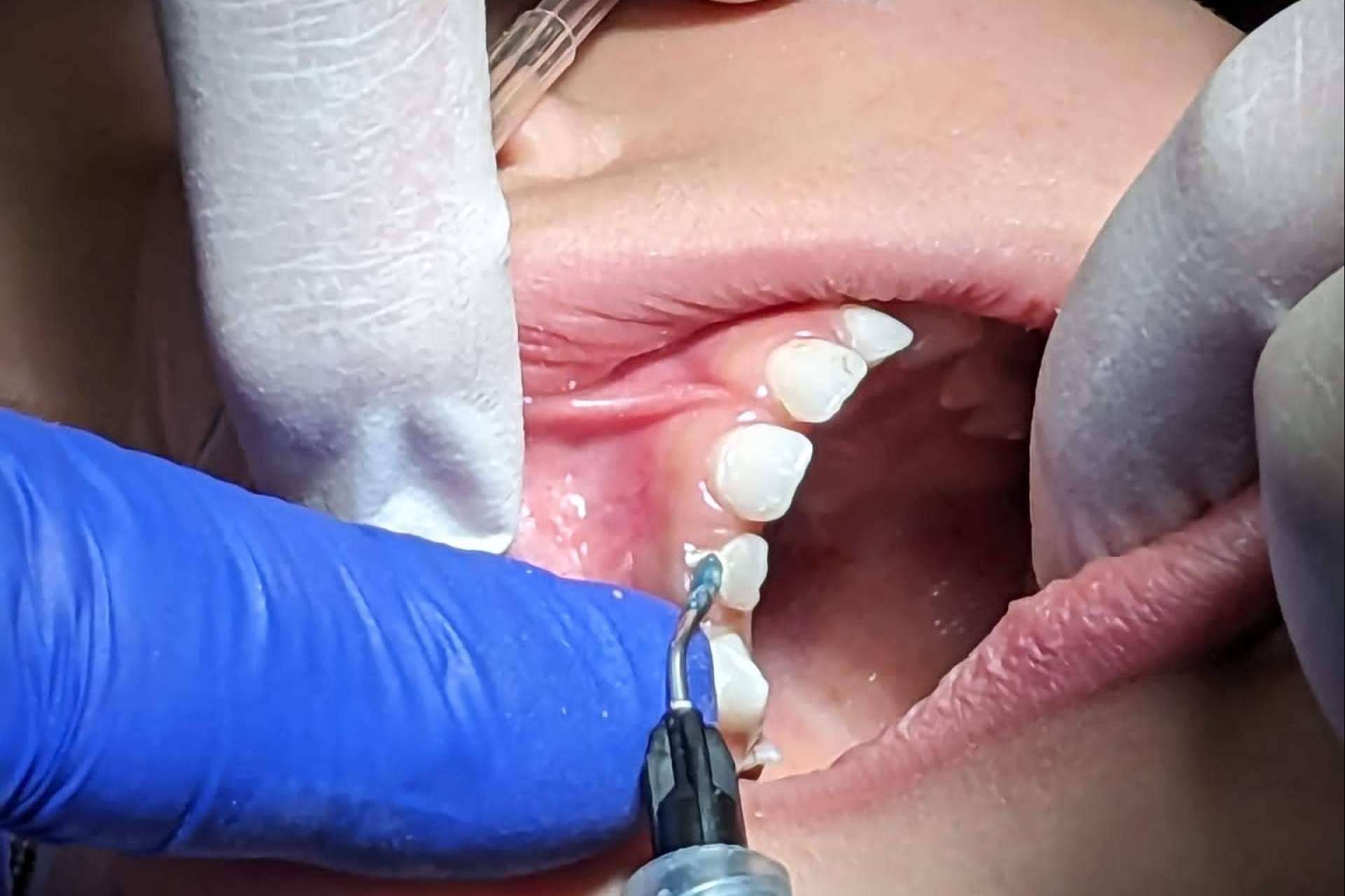 La sedación consciente para una experiencia sin miedo al dentista, Clínica Dental Ulman