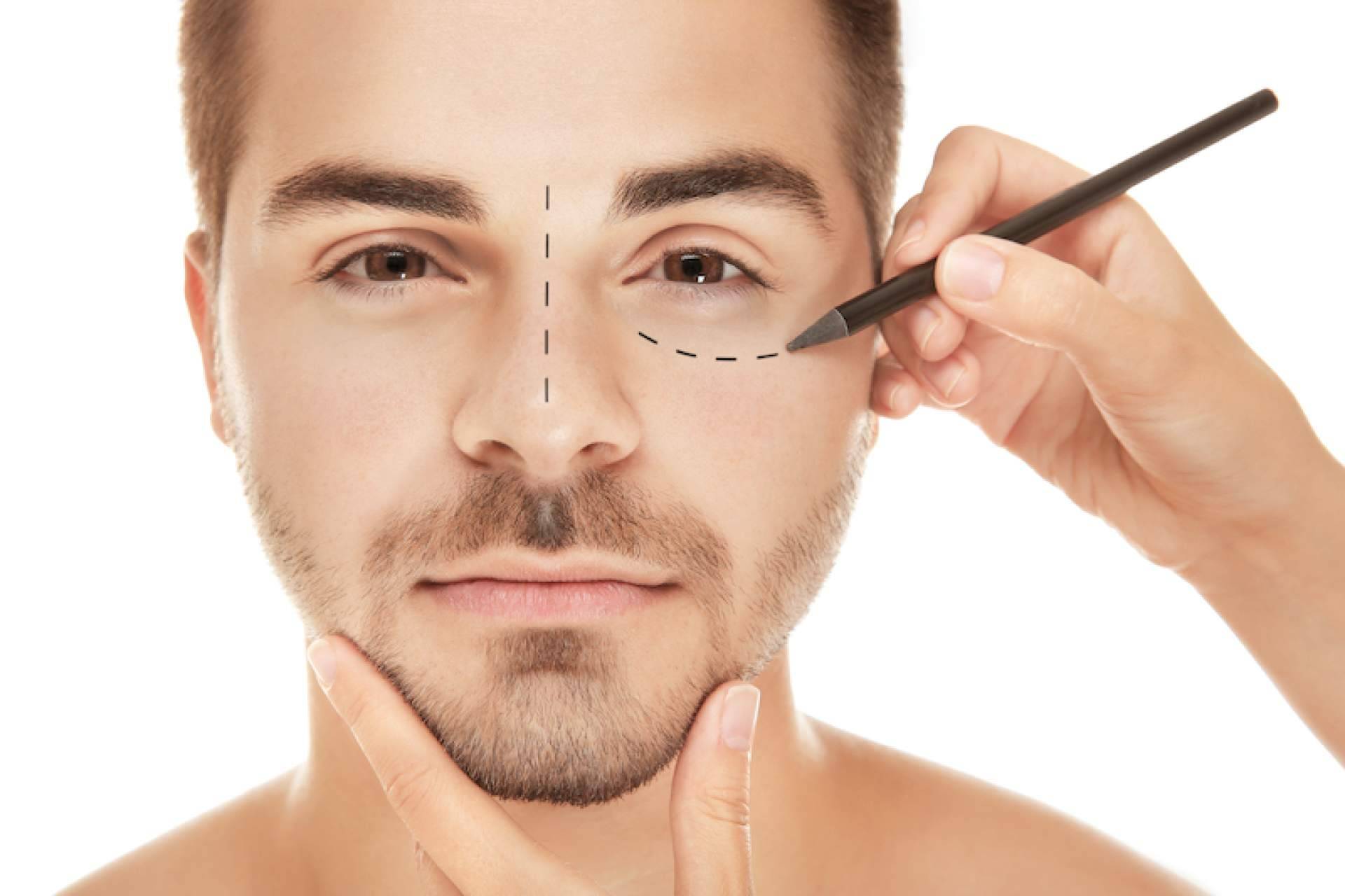 Tratar los párpados superiores e inferiores cuando existe piel redundante con la ayuda de la blefaroplastia no quirúrgica