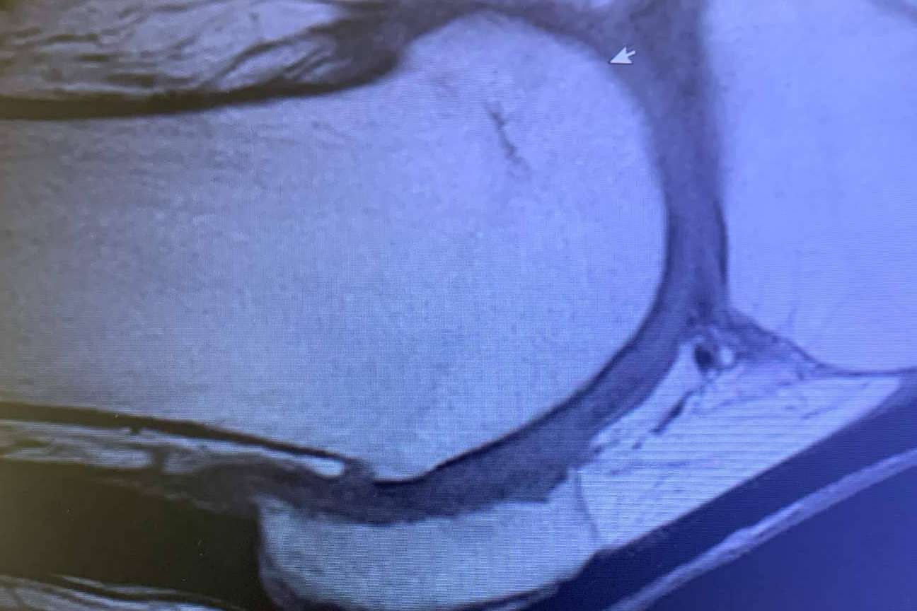Tratamientos nuevos para la artrosis y retrasar el envejecimiento del cuerpo