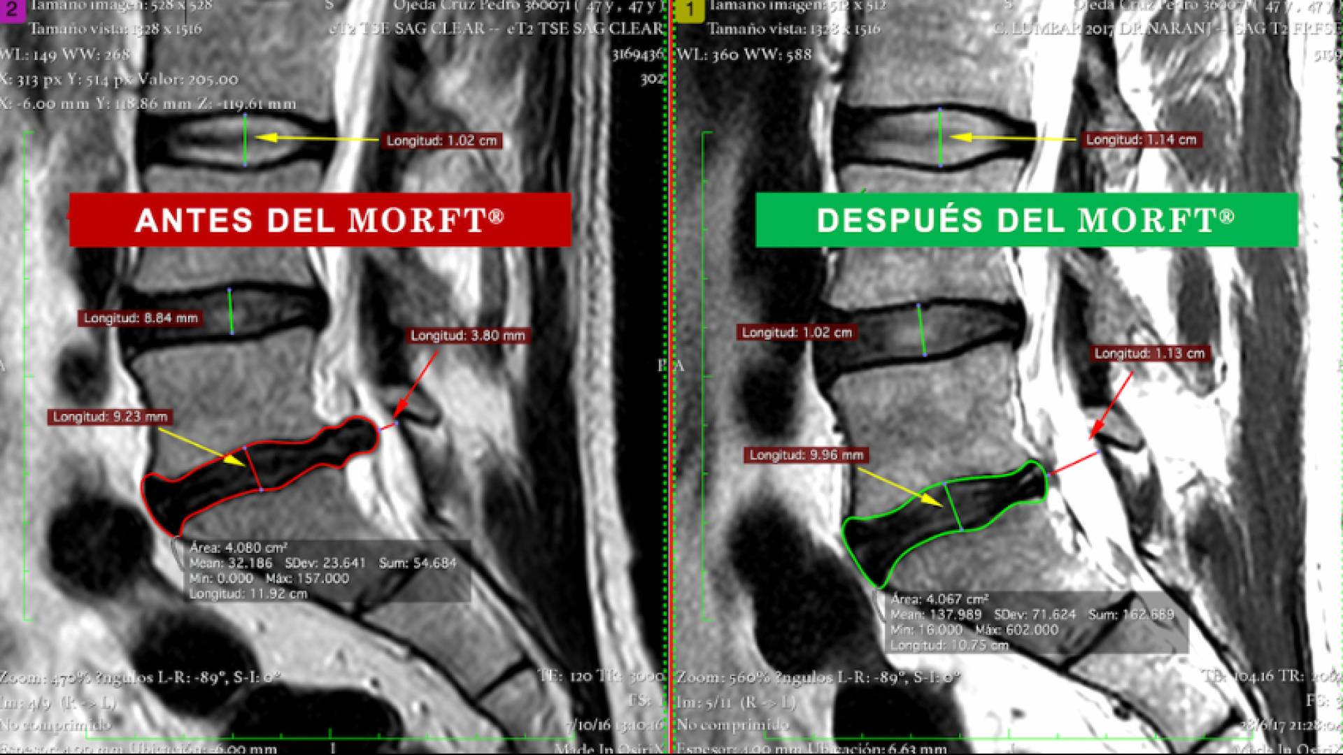 Sin medicamentos ni cirugías, el método MORFT® rehabilita a pacientes que viven con protusión y/o hernia discal
