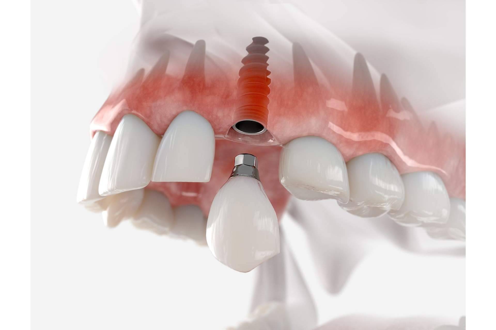 Las ventajas de un implante dental en DeltaDent