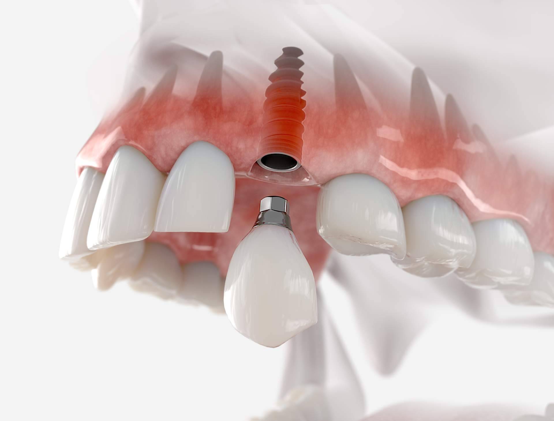 DeltaDent y las ventajas de los implantes inmediatos
