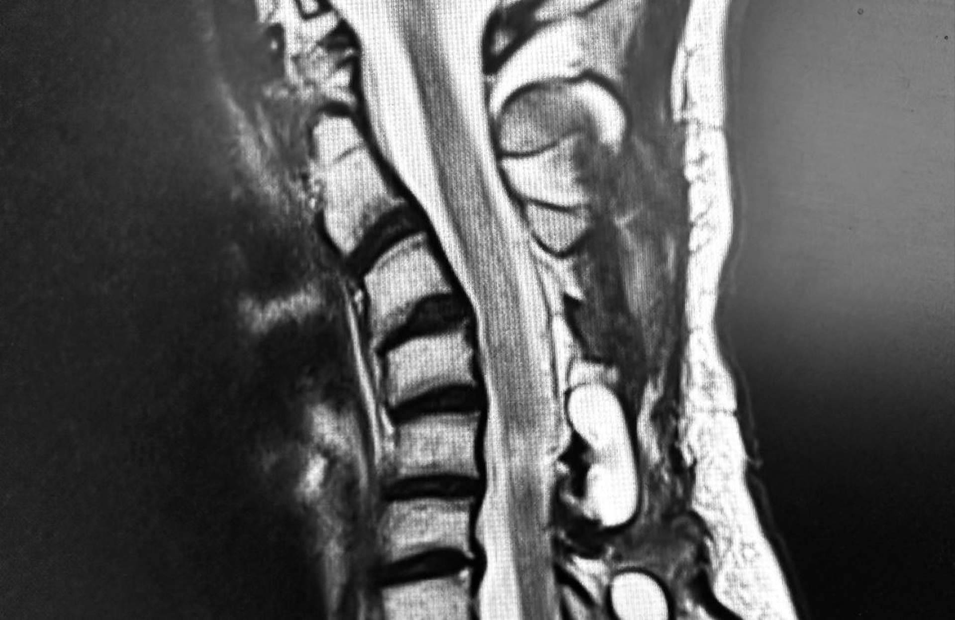 Cifosis post-laminectomía cervical, por el Dr. Botella-Asunción