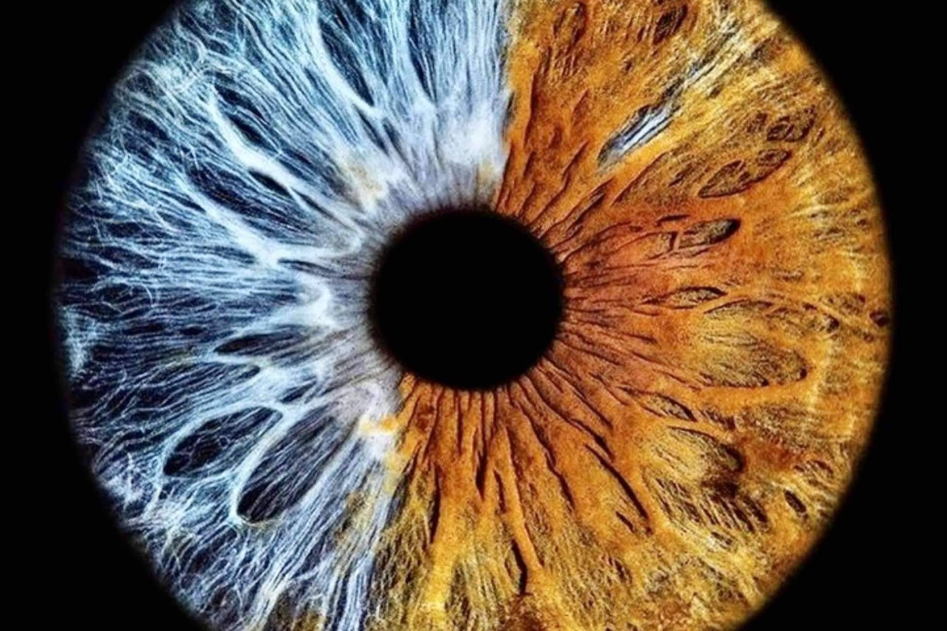 La iridoplastia laser NewEyes no perjudica la visión