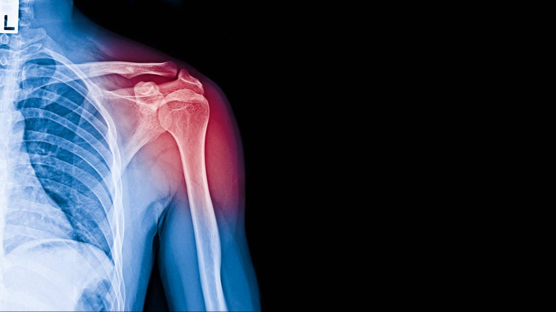 Todo lo que hay que saber sobre la tenditis de supraespinoso, por el Dr. Miguel Romero