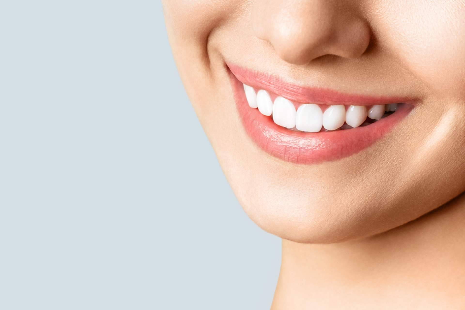 Tratamiento de microcarillas dentales sin tallado dental, en Carlos Saiz Smile