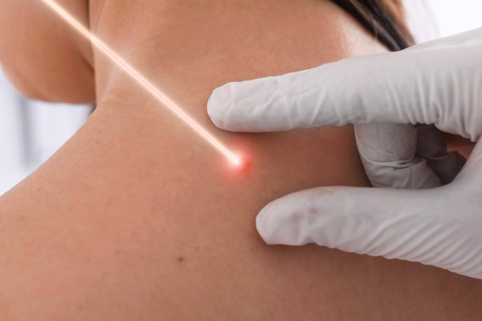 Eliminar manchas en la piel con láser con los servicios de Centro Estética El Pilar