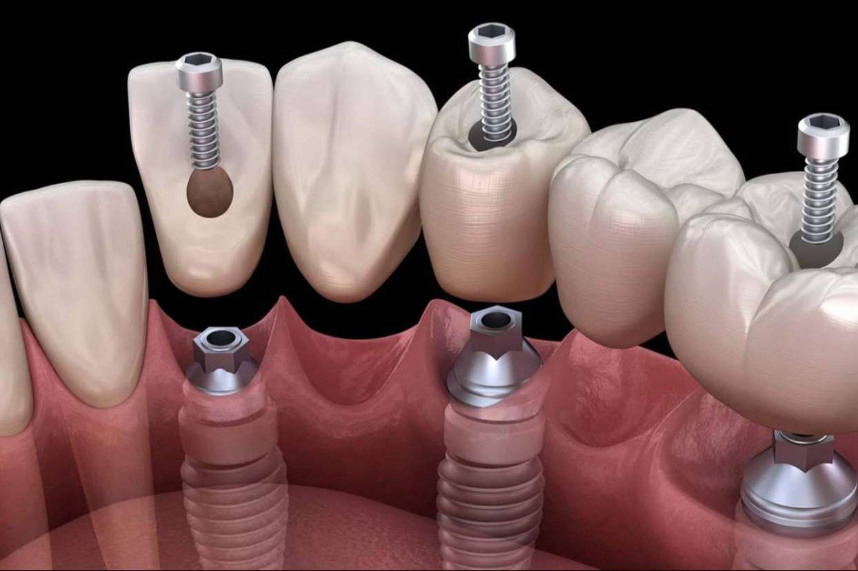 Dental Implantologie ofrece su servicio de colocación de implantes