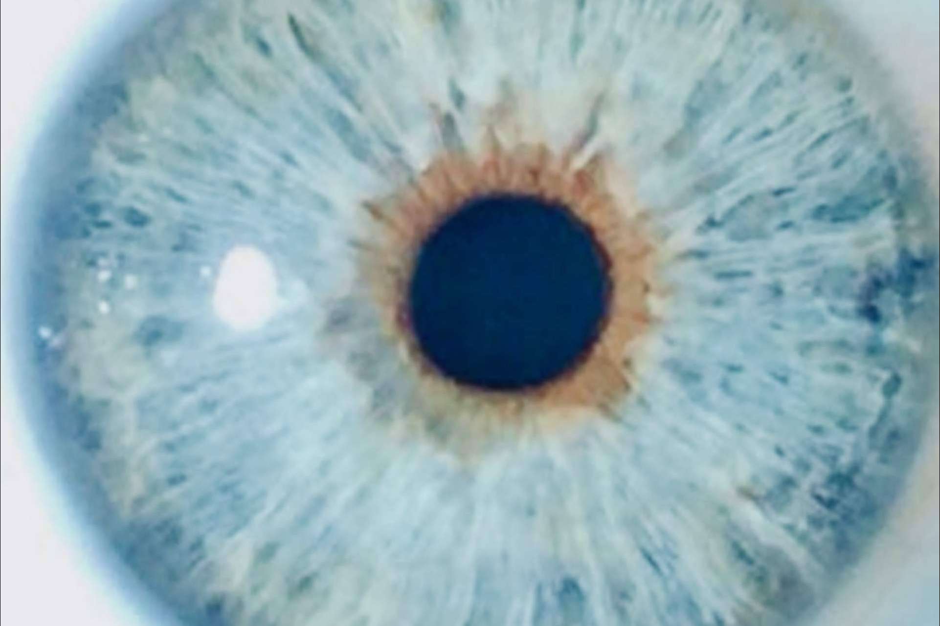 Después de la iridoplastia láser, Clínica Eyecos demuestra un riesgo mínimo de glaucoma crónico
