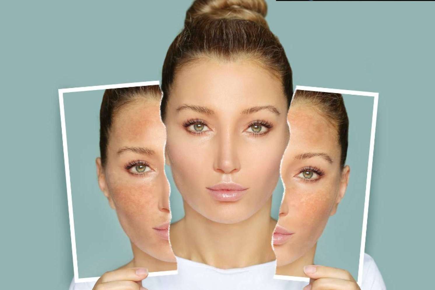 El Vortex Peel es uno de los mejores peelings de alta intensidad