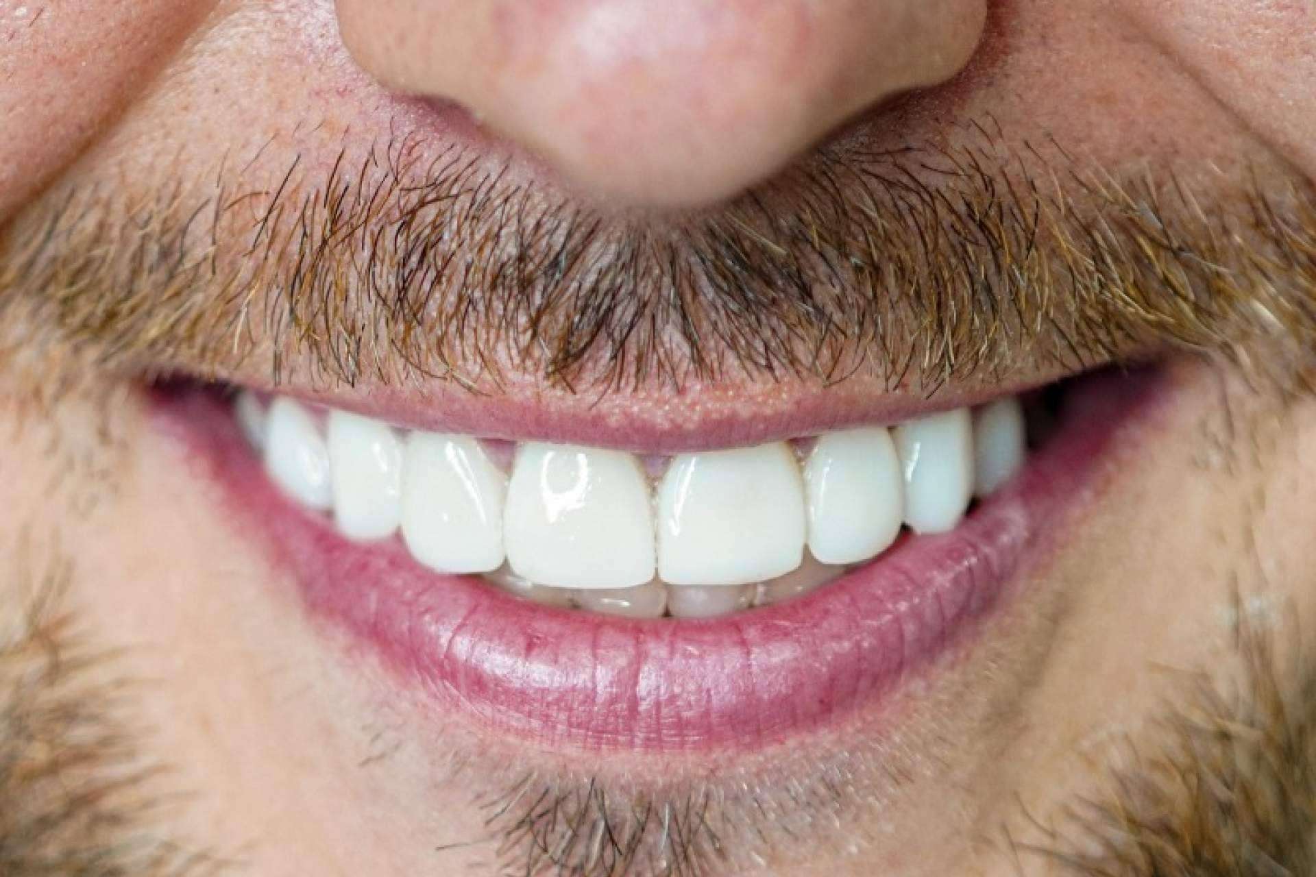 Denty Dent mejora la sonrisa de sus pacientes con tratamientos de estética dental
