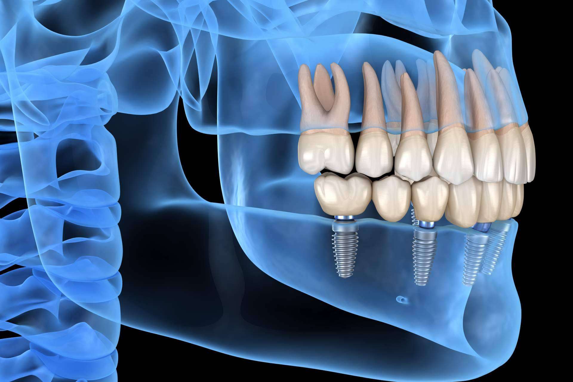 Recuperar la mejor versión de la sonrisa gracias a los implantes dentales inmediatos de DeltaDent