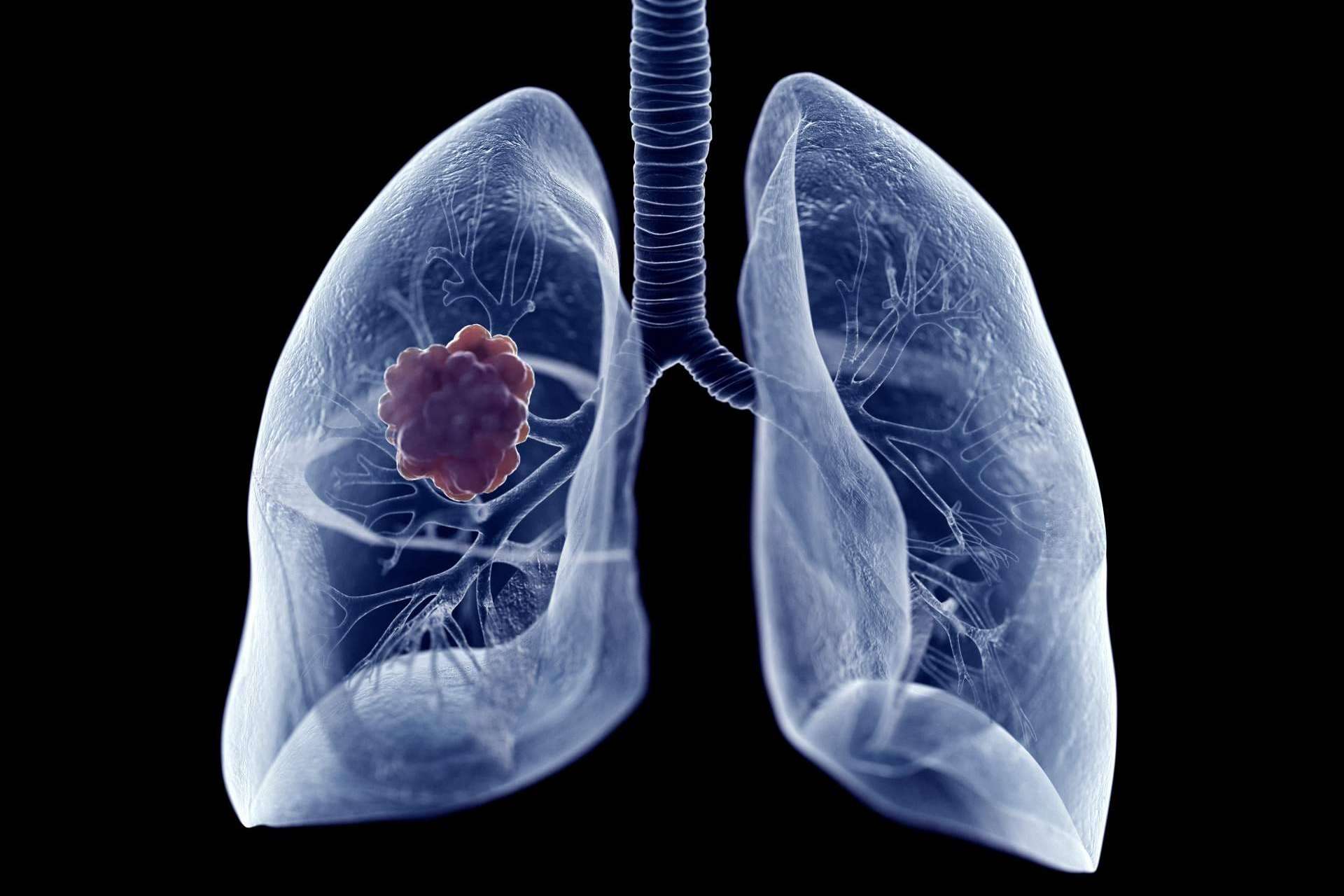 El tratamiento de cáncer de pulmón con Oncothermia (Nanothermia)