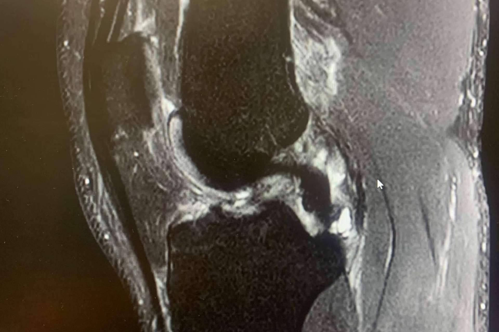 Regeneractiva habla de la prevención de las lesiones de ligamento cruzado anterior