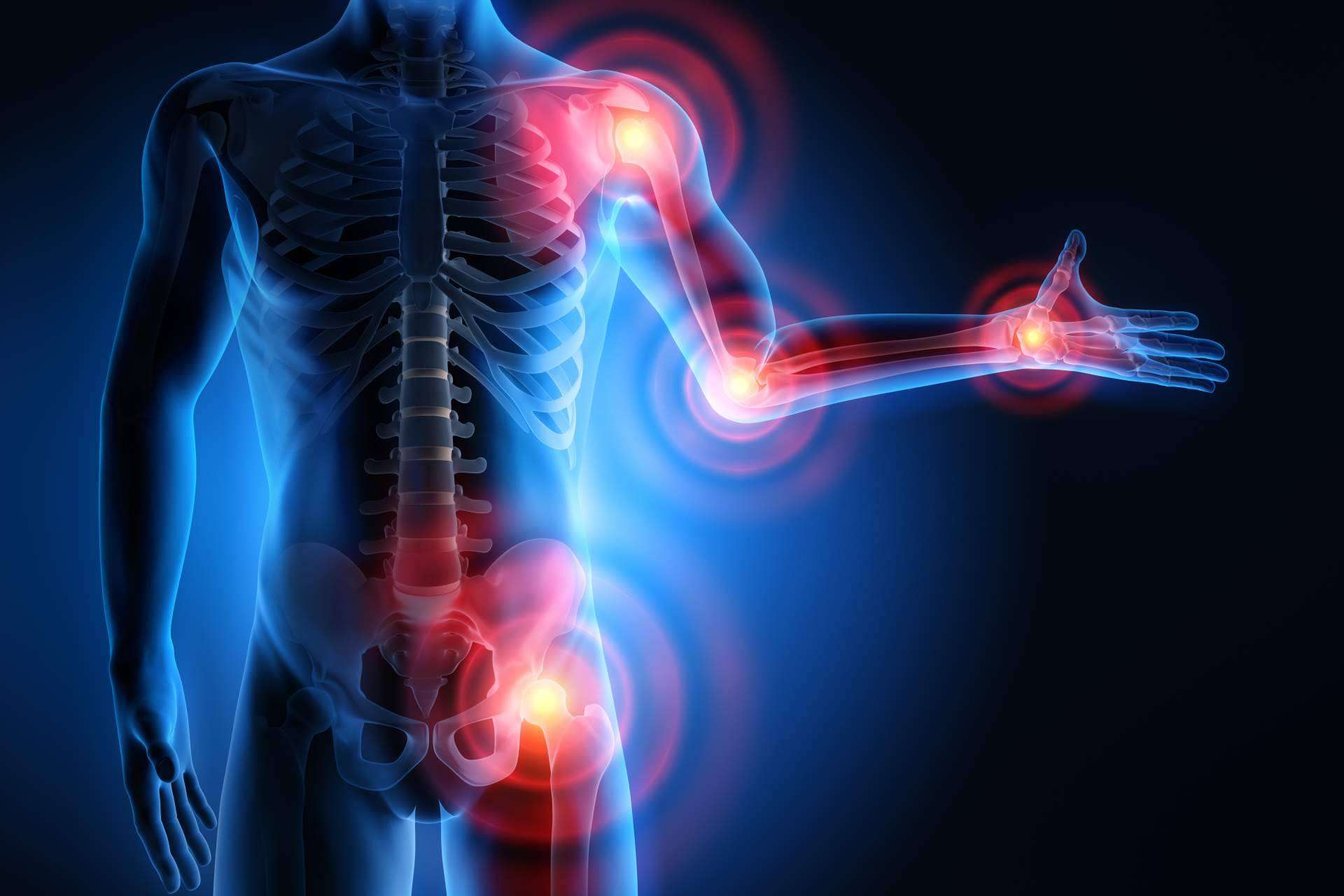 Osteoartritis tratamiento, de la mano de Phytogen Medical Foods