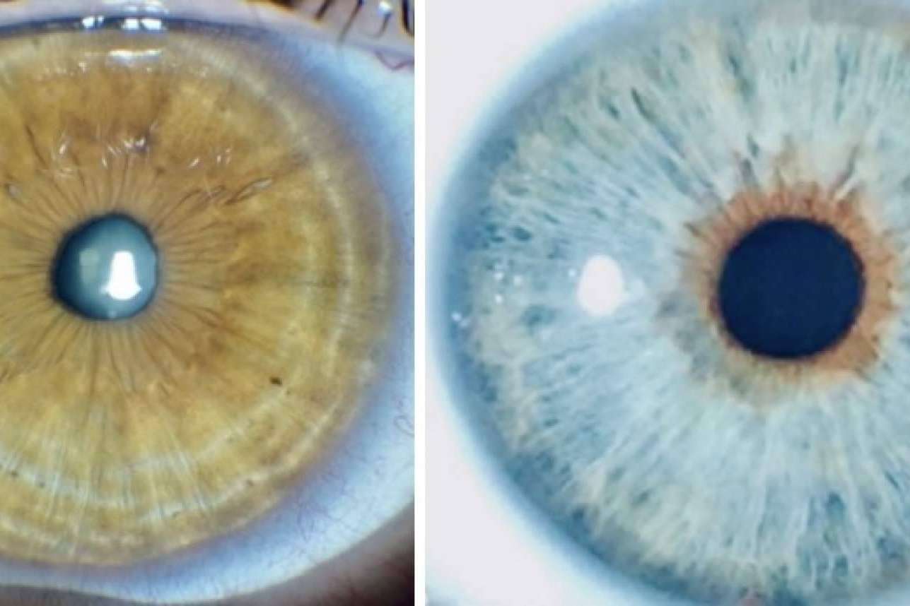 Eyecos permite predecir y simular en 3D el resultado del cambio de color de ojos con láser