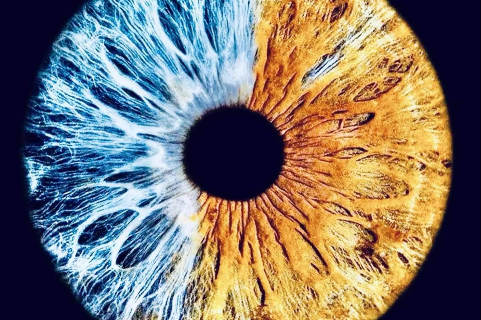 ¿Qué son las heterocromías congénitas?, por Eyecos