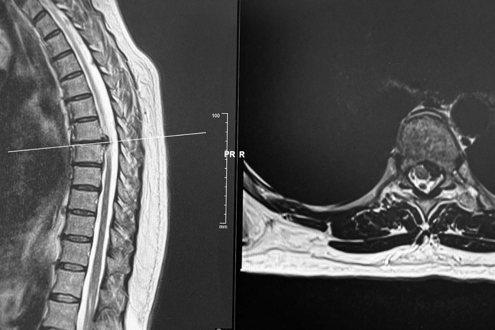 El neurocirujano Dr. Carlos Botella-Asunción es especialista en cirugía de hernia discal