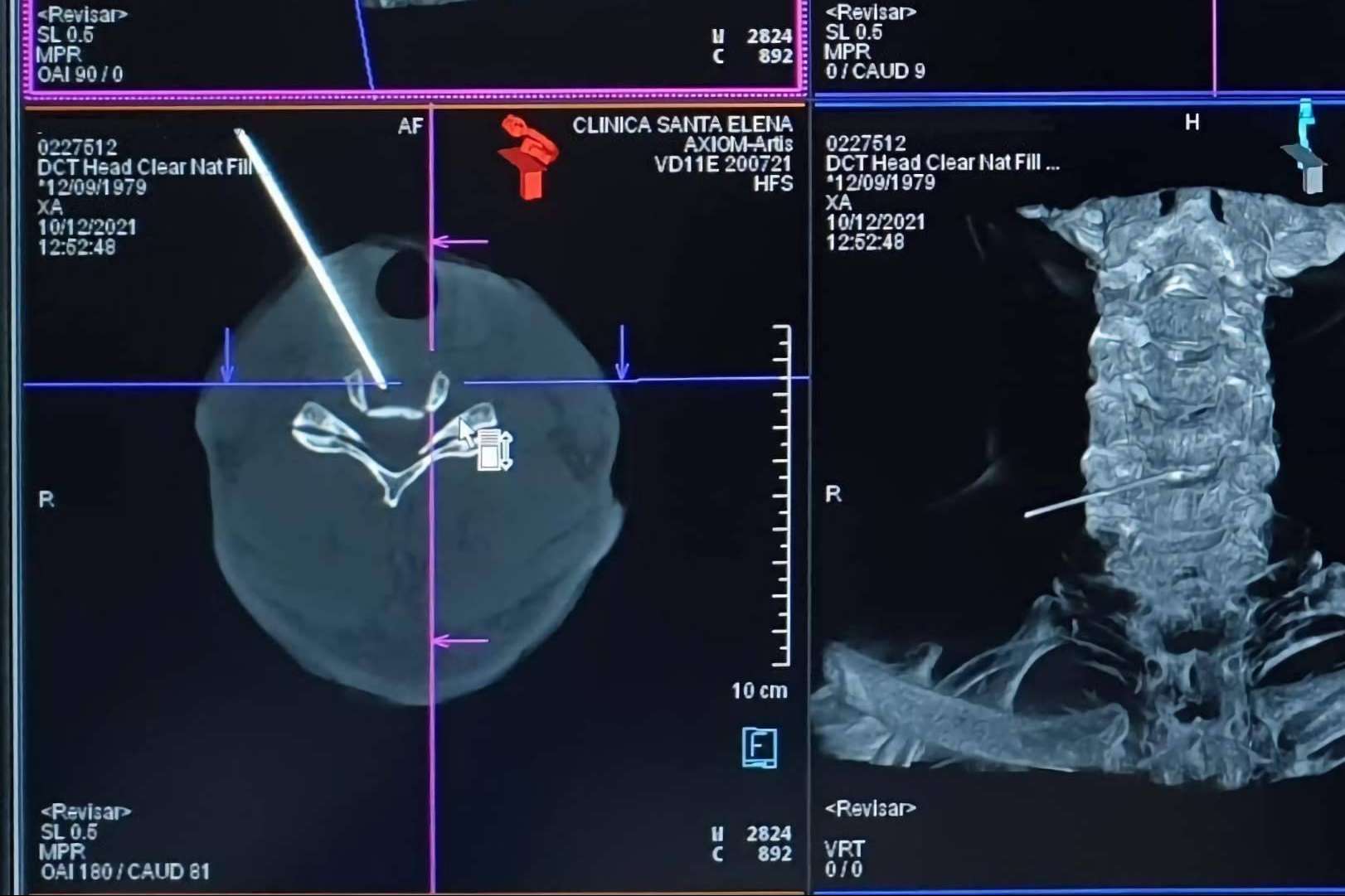 El 82% los pacientes con hernia discal responden al tratamiento láser, en una sola sesión