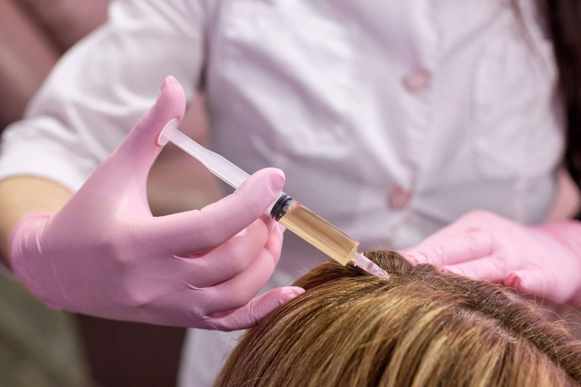 Por qué tratar la alopecia con mesoterapia capilar con fármacos