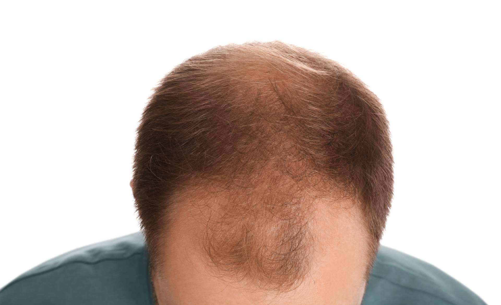 Plasma capilar PRP, un método innovador para tratar la pérdida del cabello con Centro Estética El Pilar