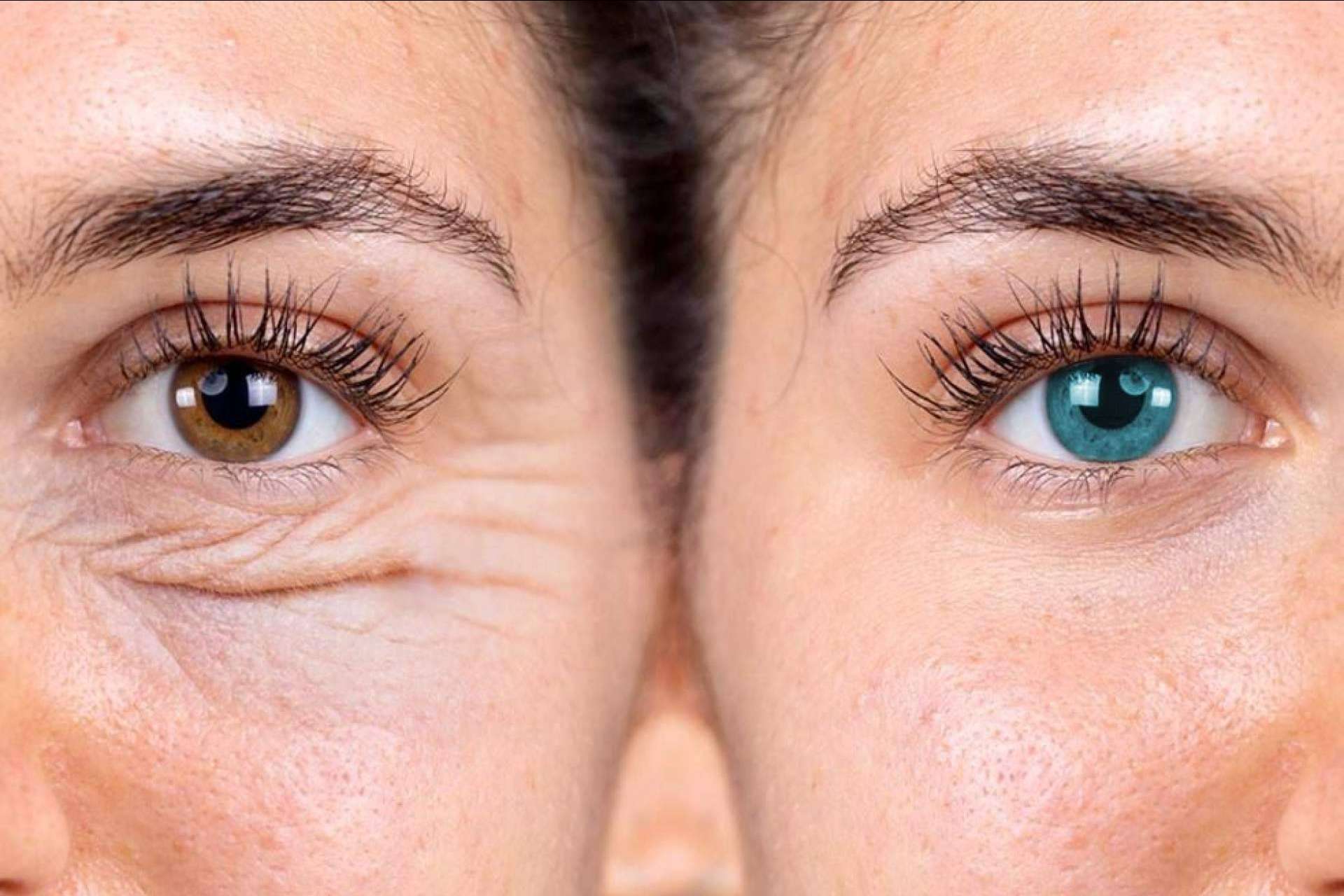 Nueva era en estética facial, cambio de color de ojos con Eyecos