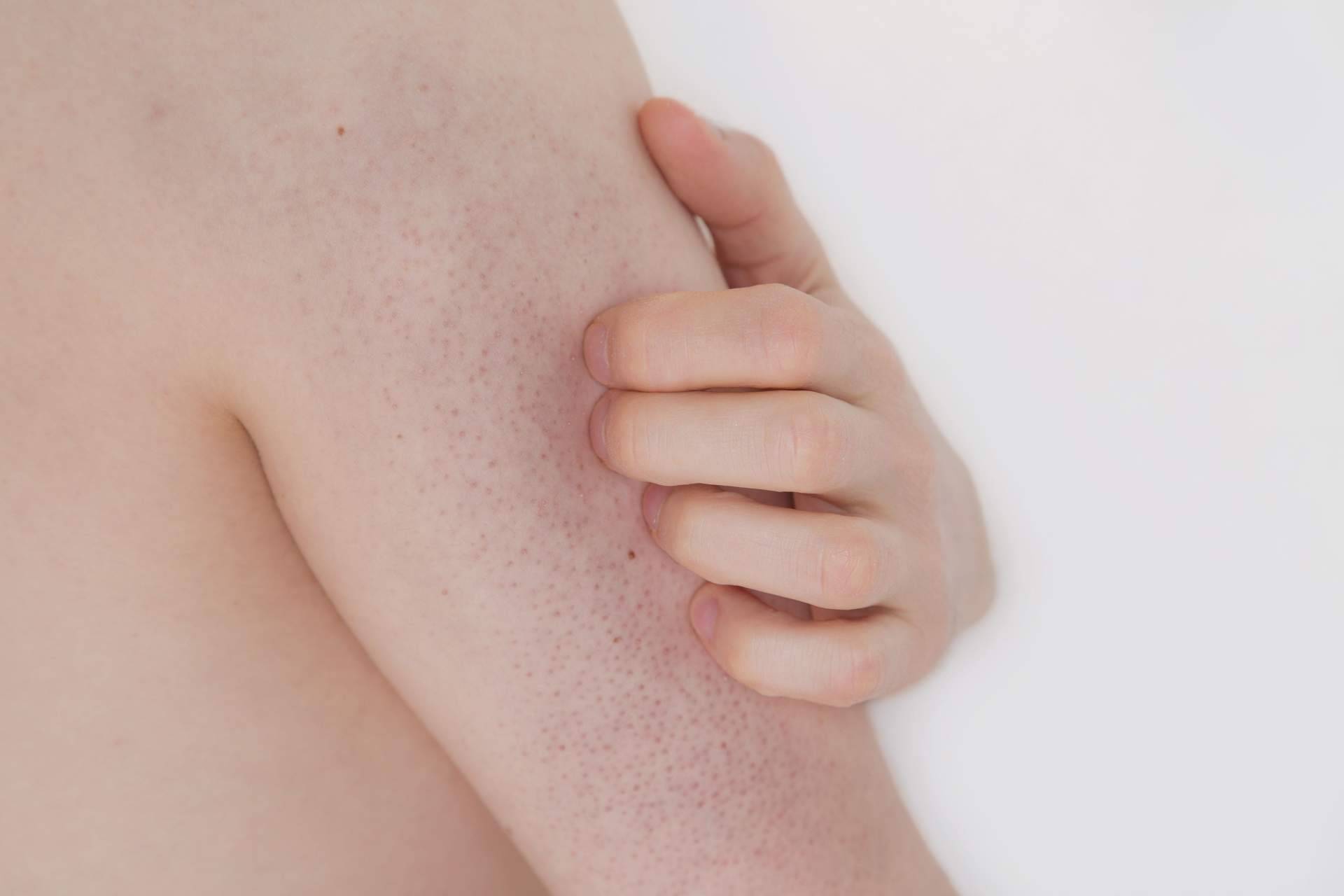 La Dra. Janeth Arévalo sugiere algunos tips para aliviar los síntomas de la queratosis pilaris