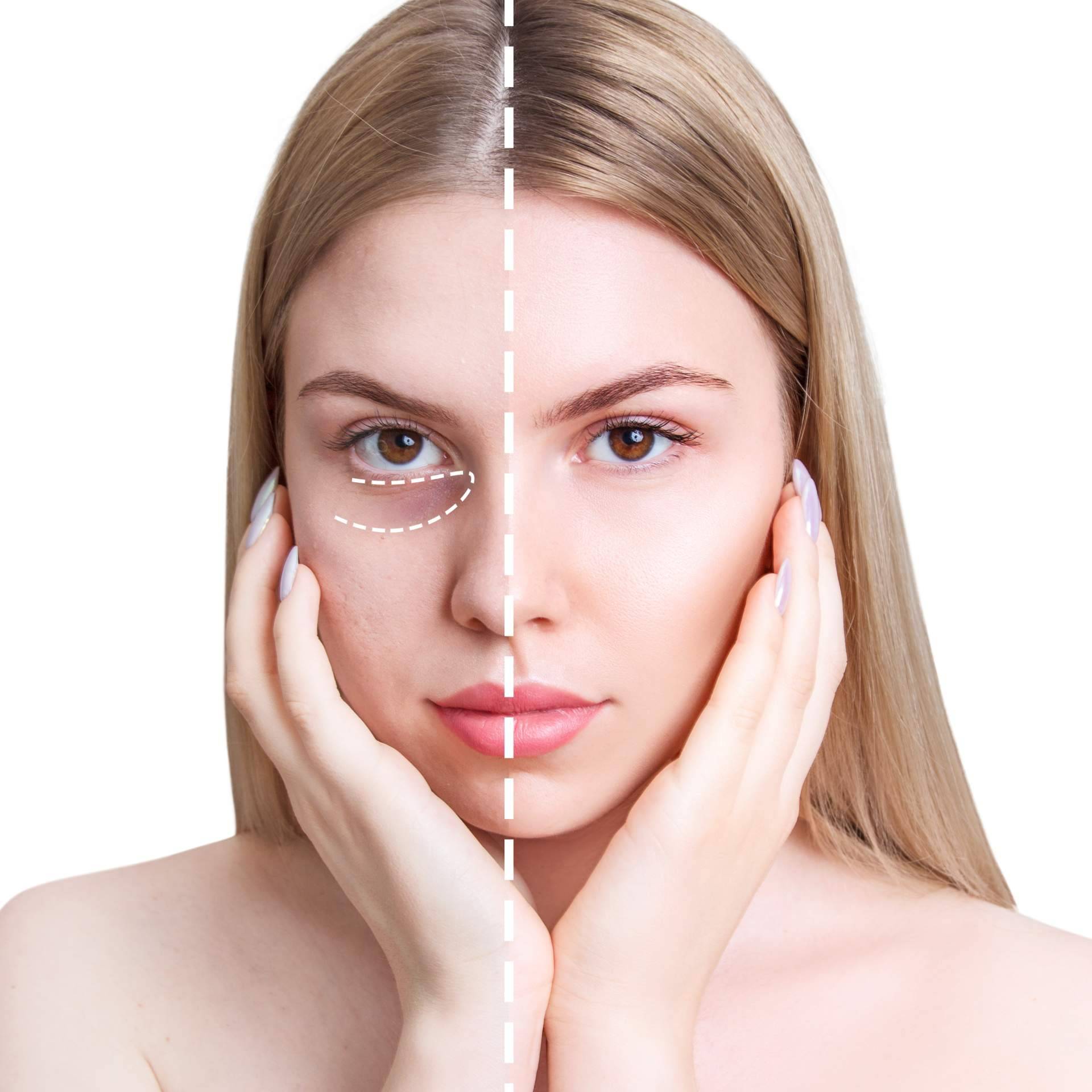 Cómo deshacerse de las ojeras con ácido hialurónico, en Centro Estética El Pilar