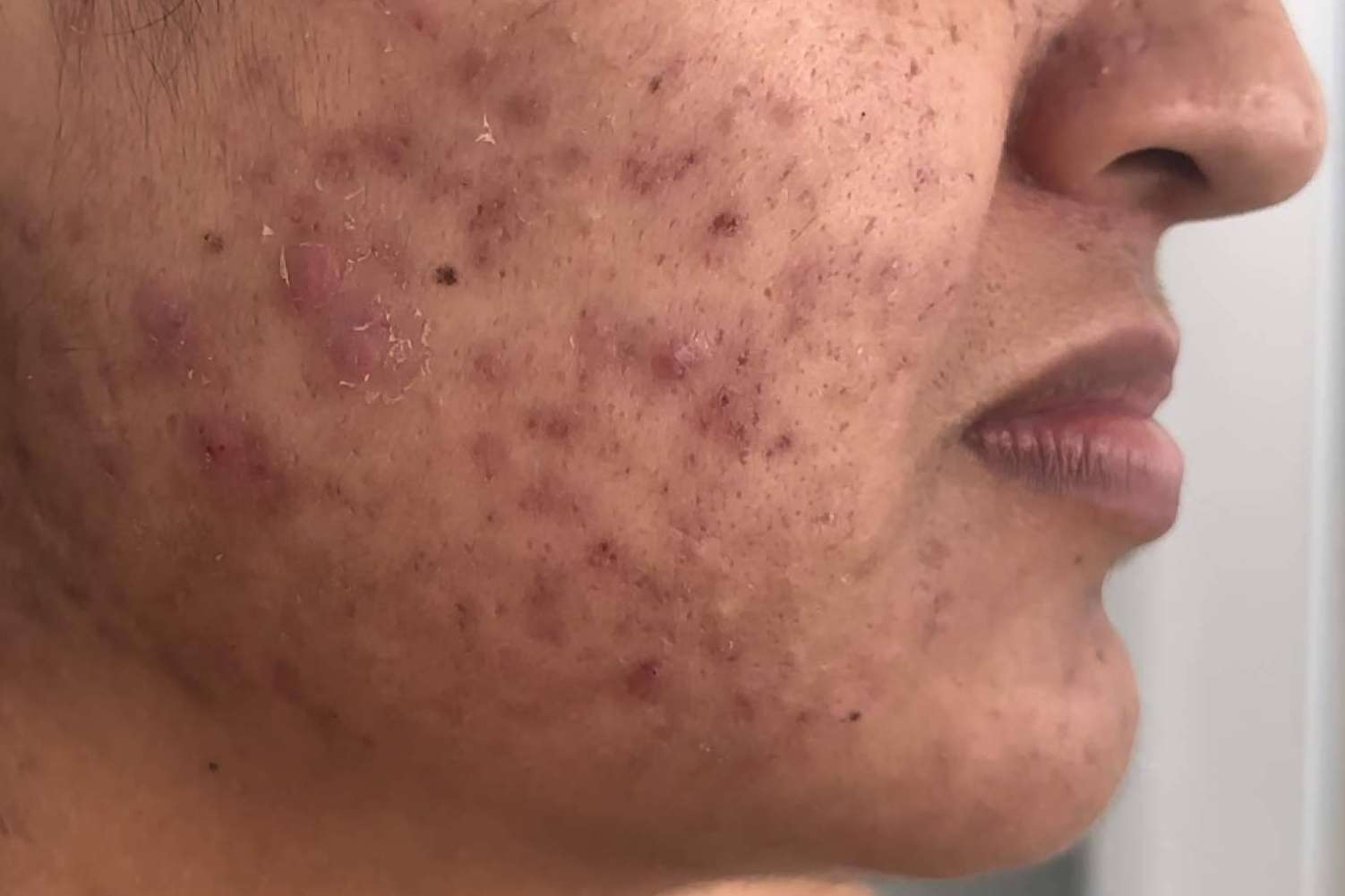 Acné hormonal como consecuencia del síndrome del ovario poliquístico y el exceso de vitamina B12, por la Dra. Janeth Arévalo