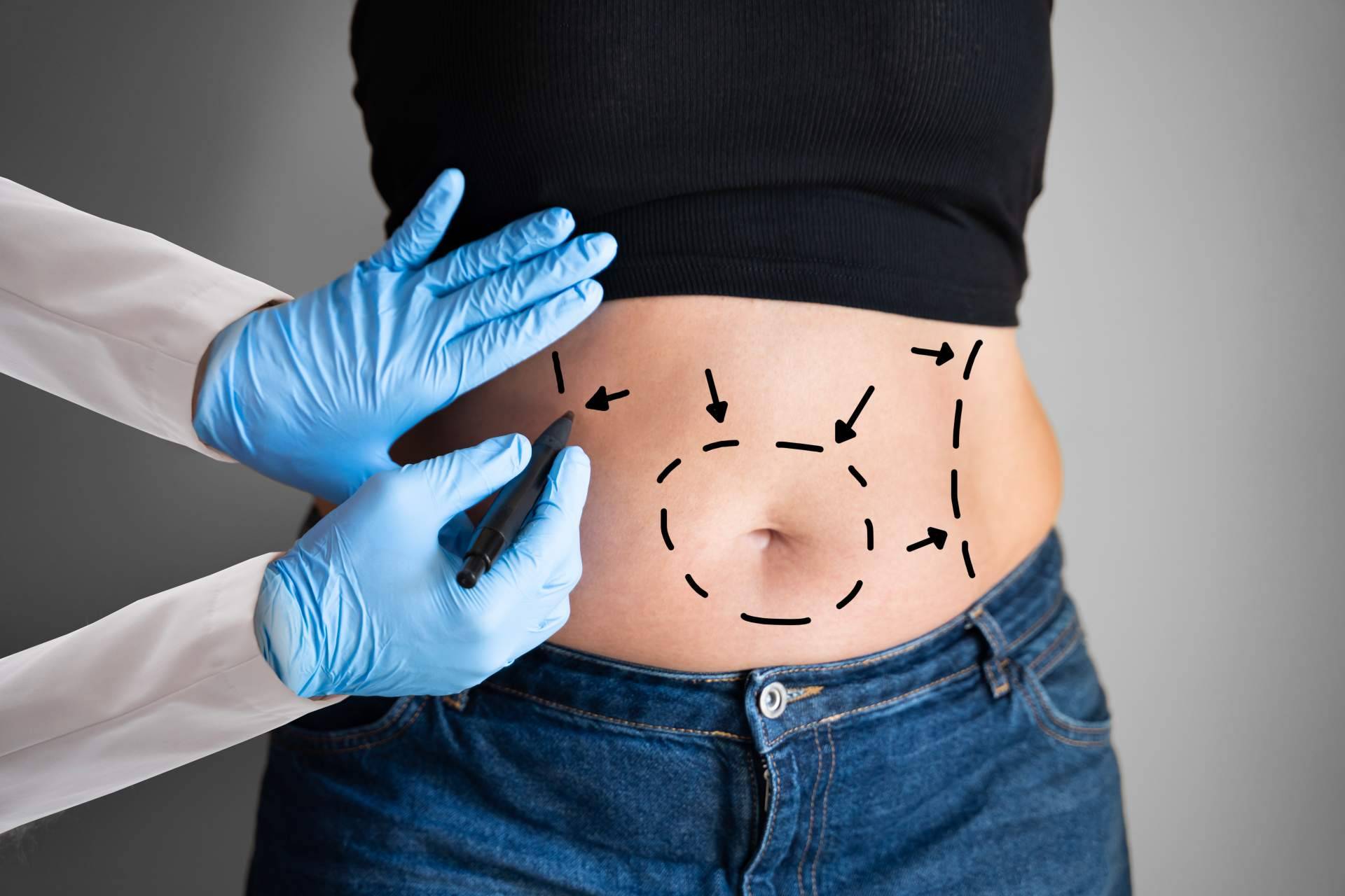 La abdominoplastia, una solución para eliminar la barriga y recuperar el vientre plano tras un embarazo