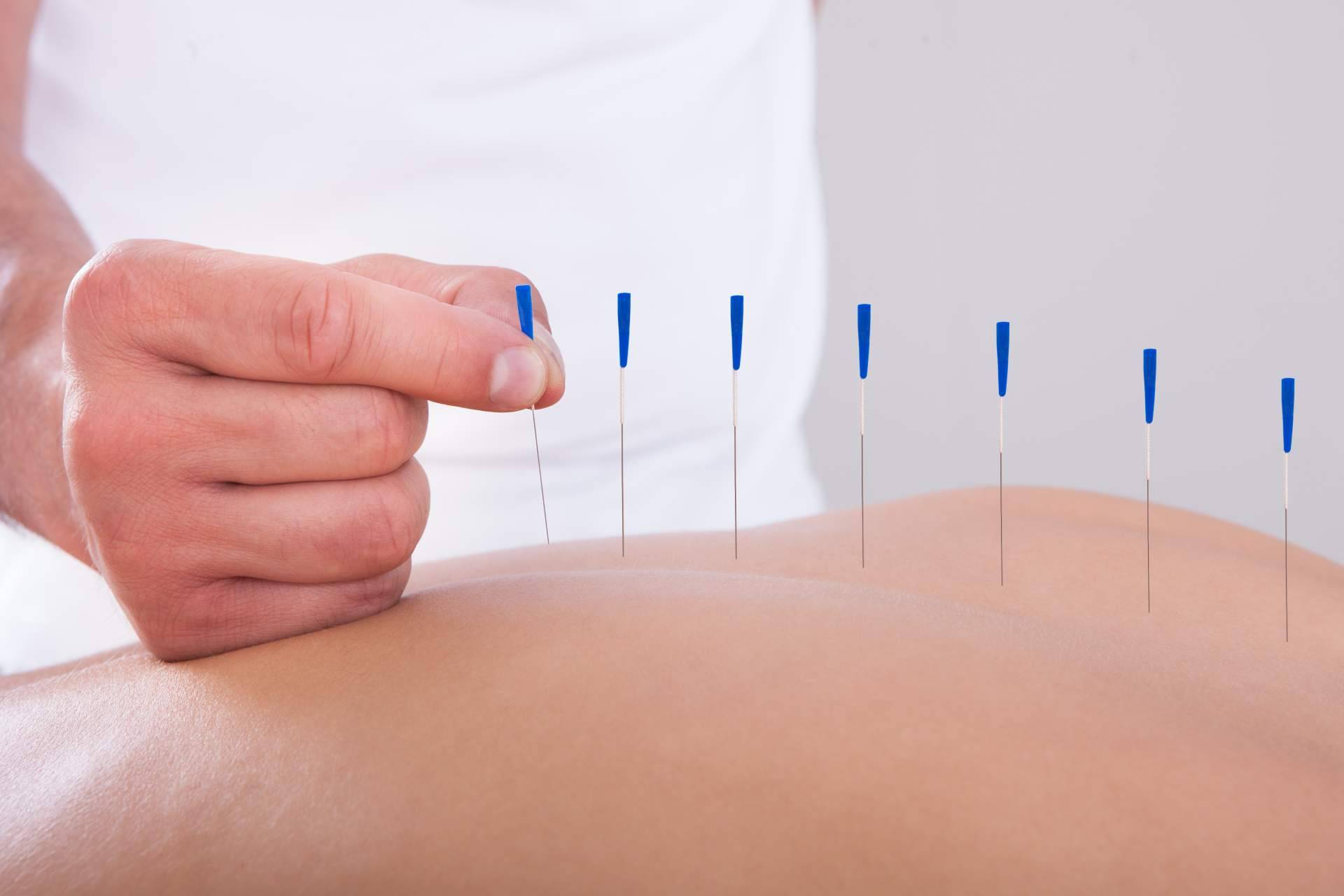 Tratamientos personalizados de acupuntura en Málaga de la mano de Vital Balance