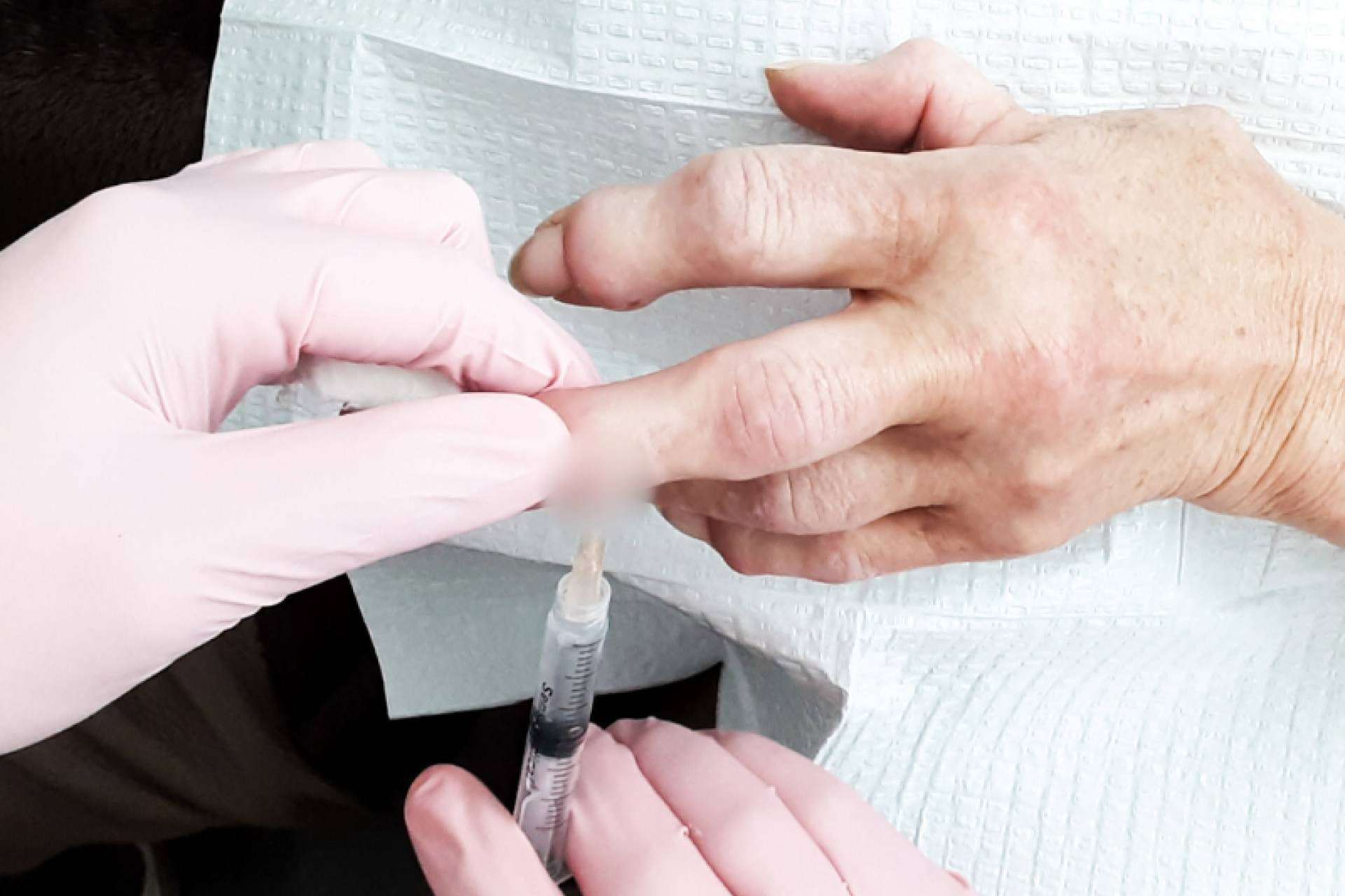 La medicina regenerativa como esperanza para pacientes con artritis reumatoide