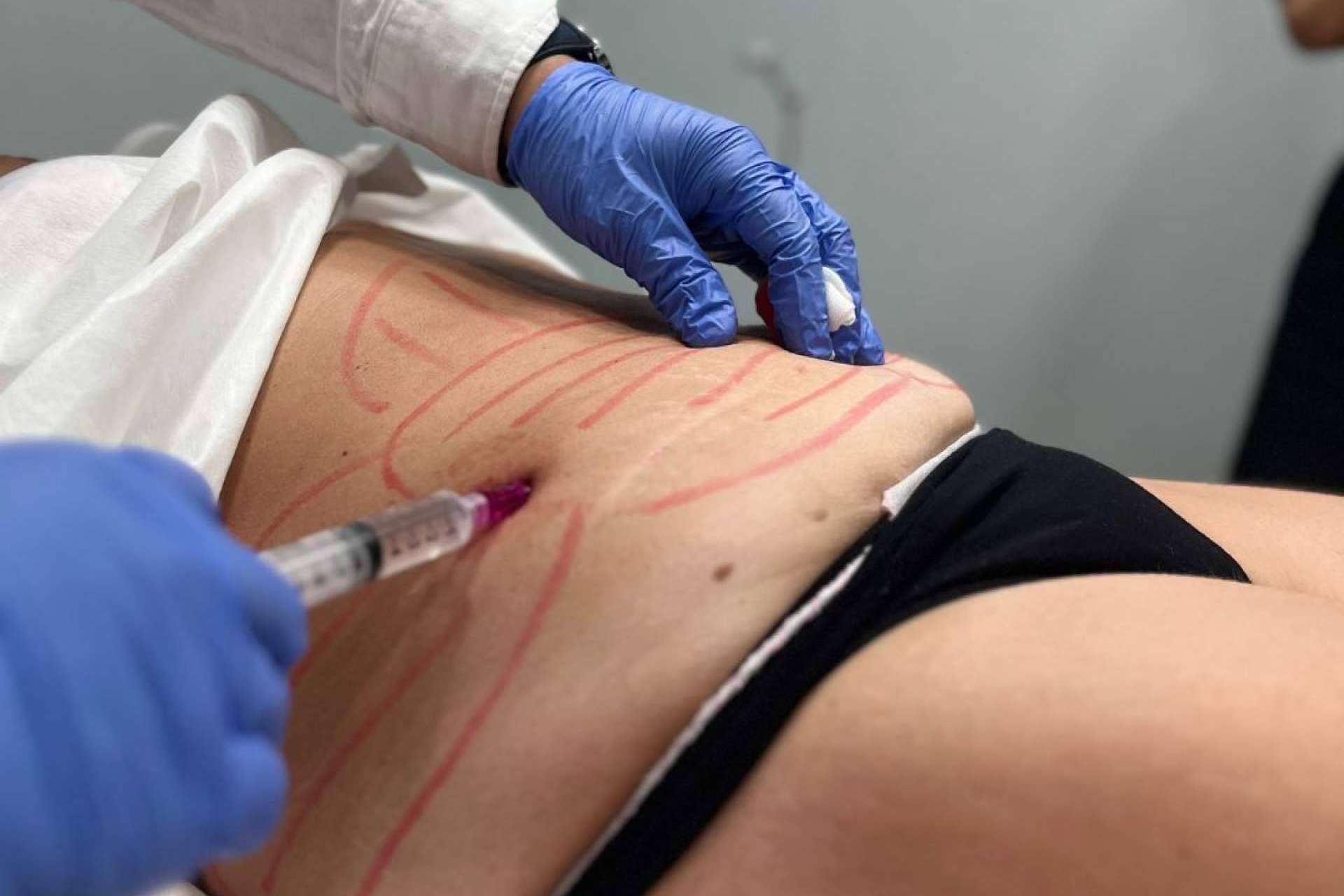 Remodelación corporal sin cirugía, Lipoláser Fit se consolida como opción destacada en medicina estética