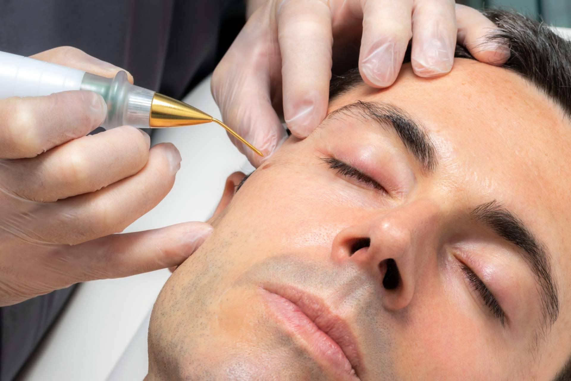 Centro Estética El Pilar ofrece soluciones avanzadas para la eliminación de lunares y verrugas sin cirugía