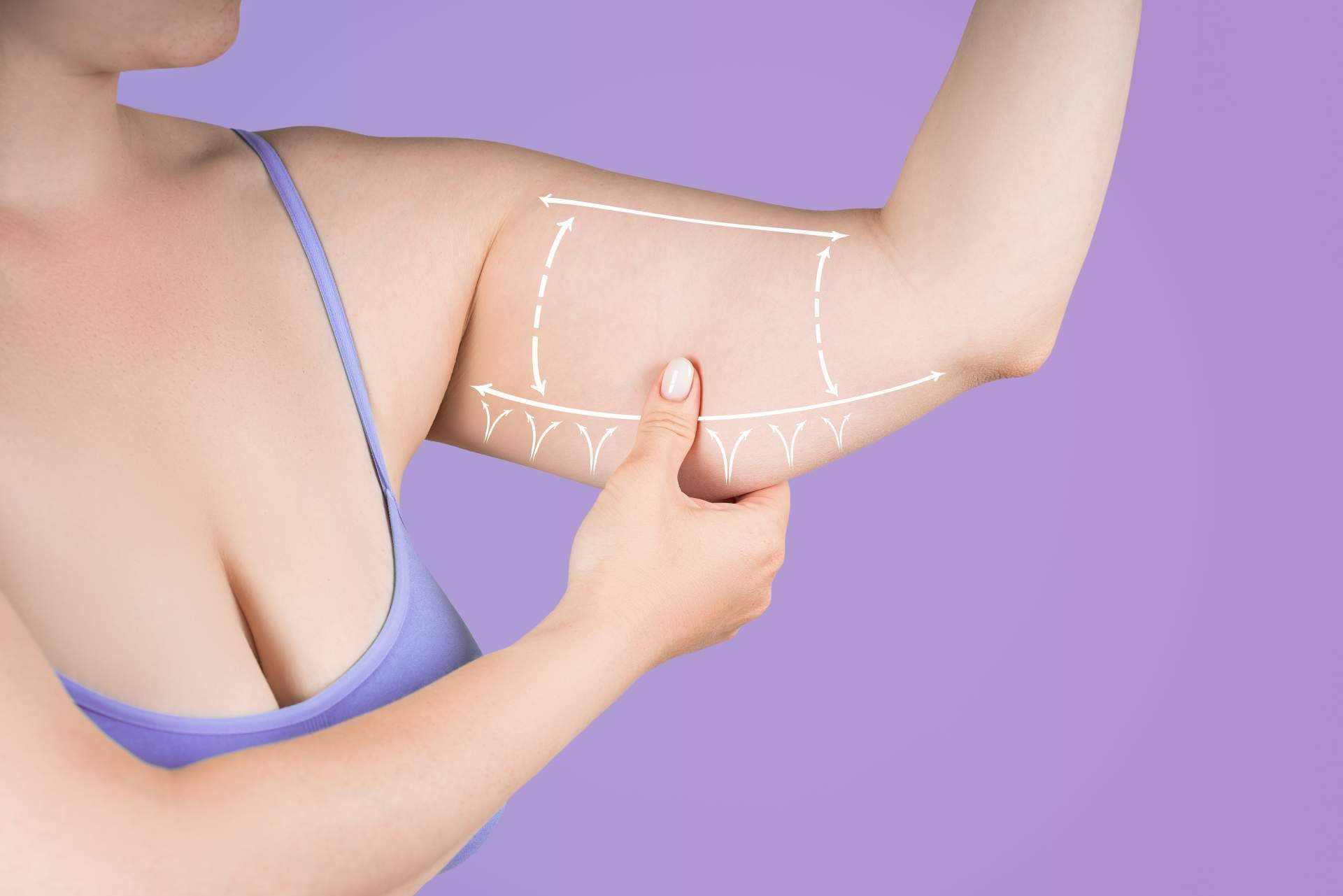 Beauty&Beauty expande su servicio de lifting de brazos en seis ciudades clave de España