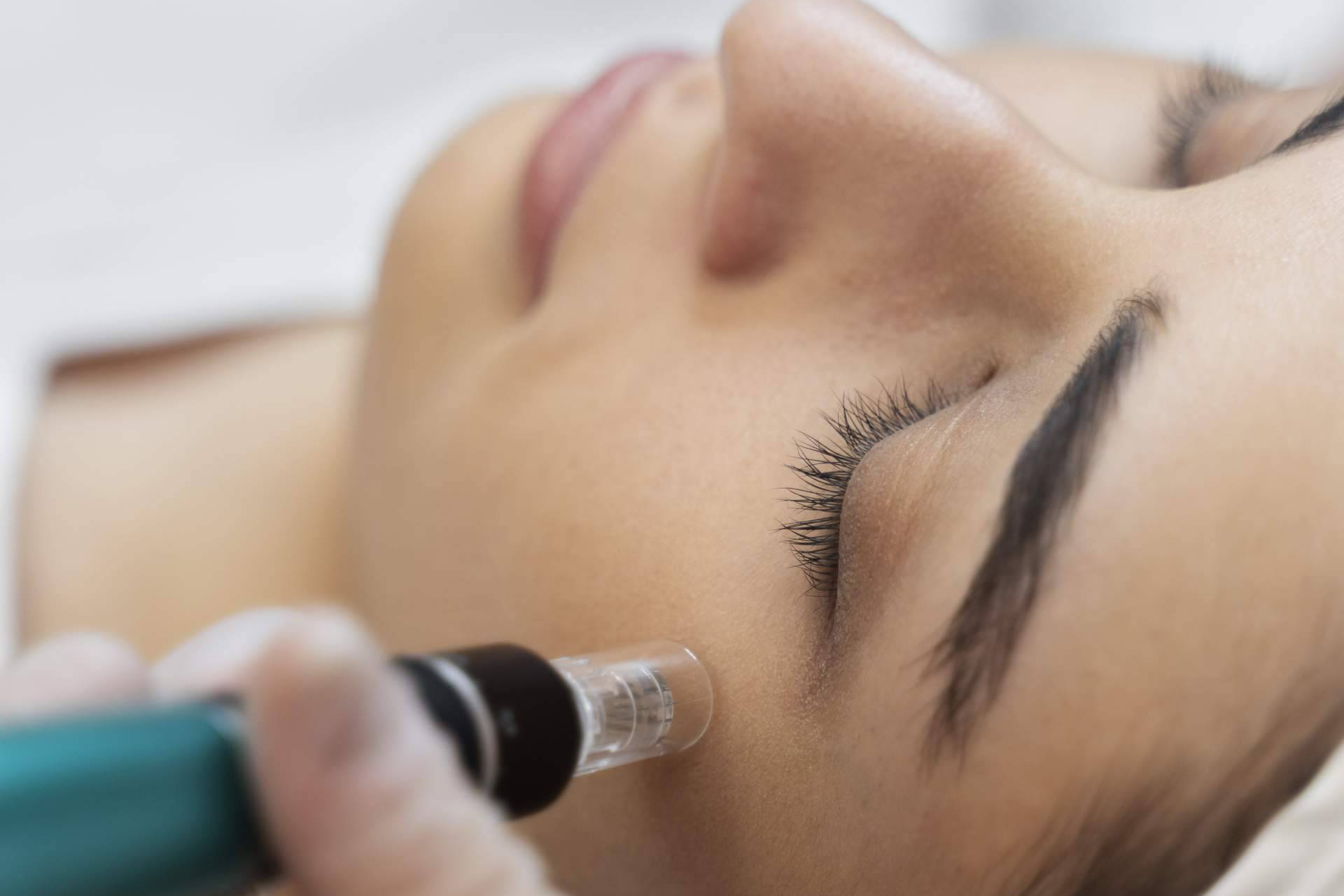 'Dermapen', el método de rejuvenecimiento cutáneo que marca tendencia en estética avanzada