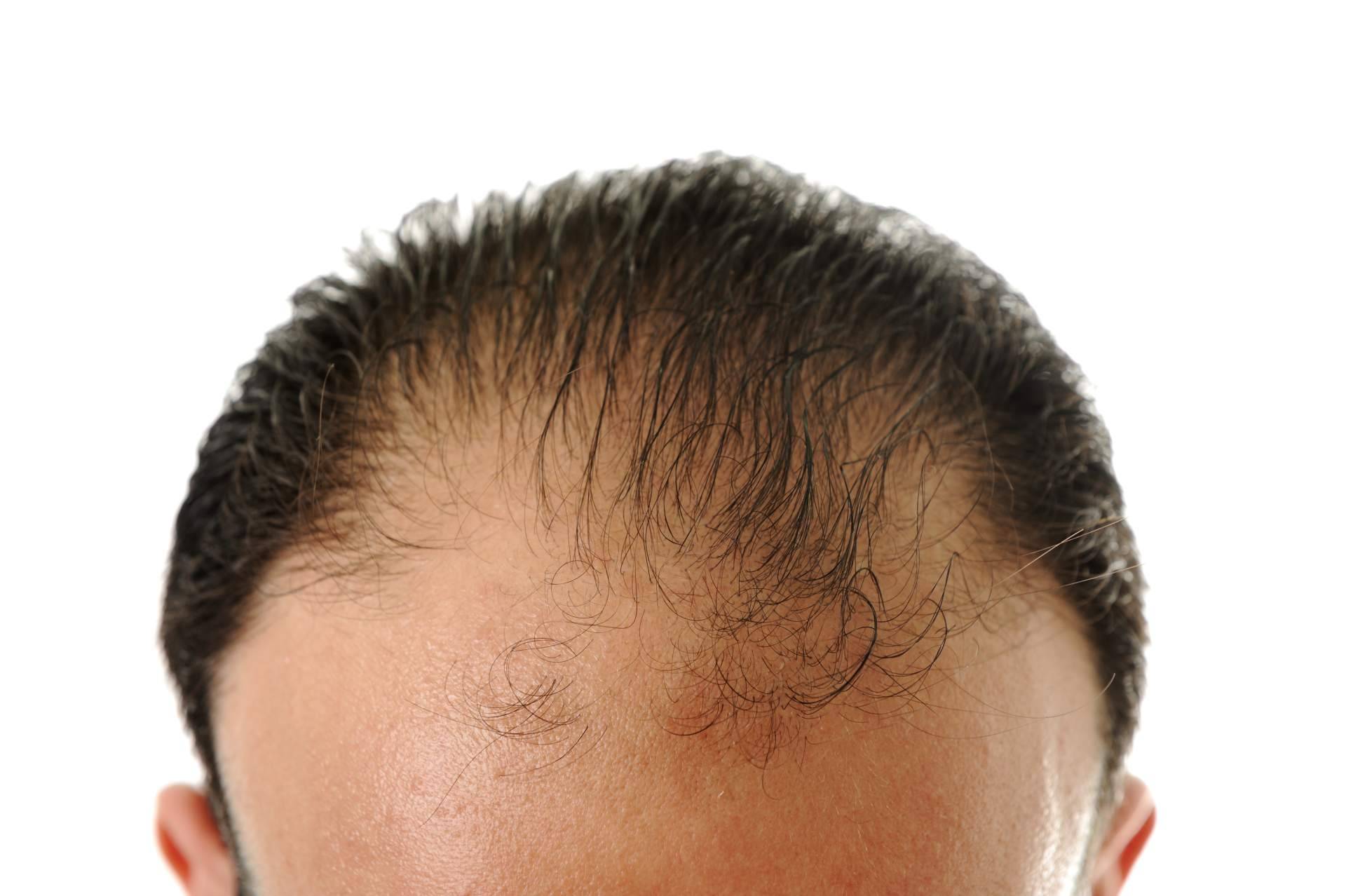 Evocapil se posiciona como referencia en tratamientos para la caída del cabello con respaldo clínico
