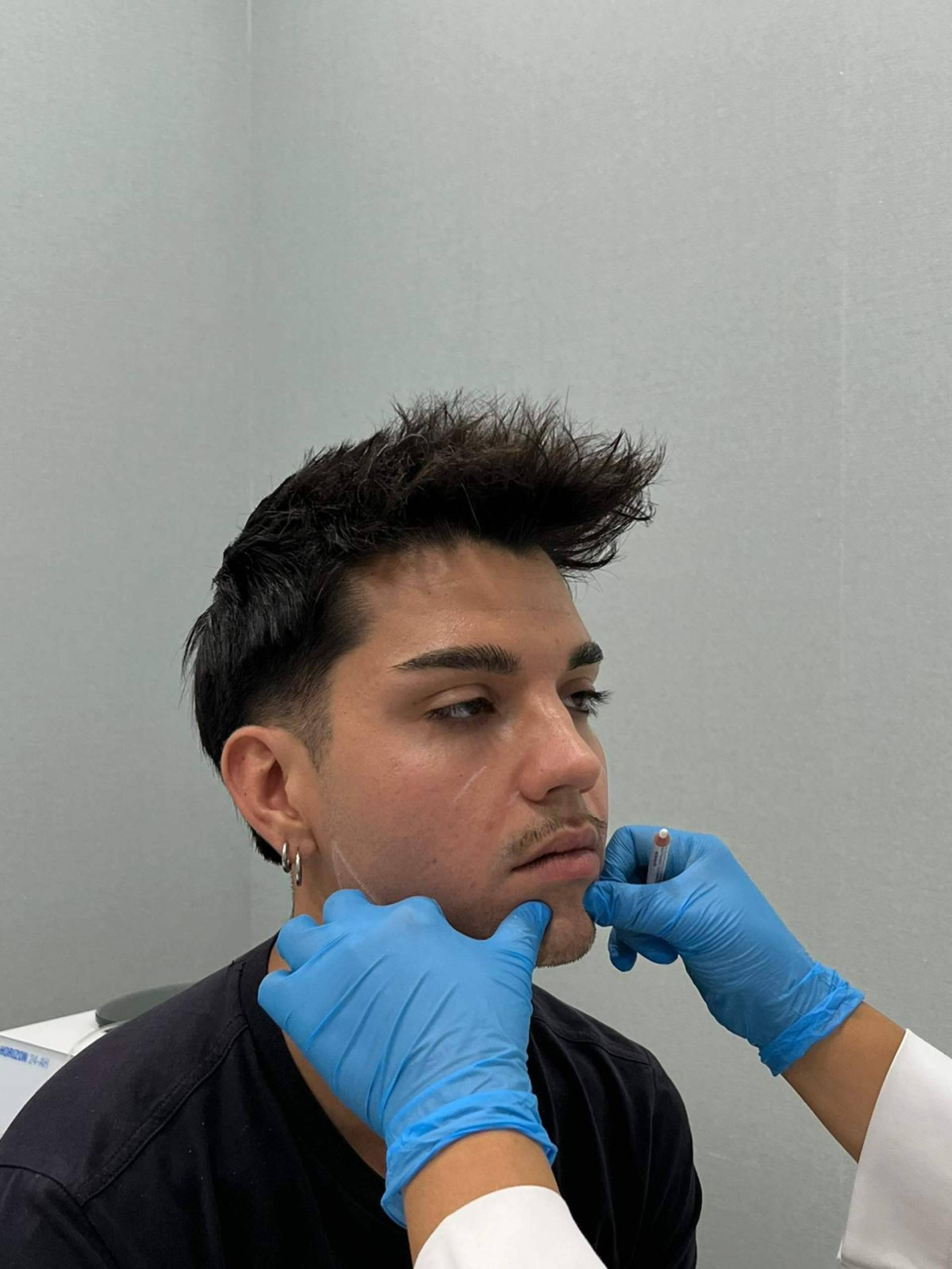 Cómo la medicina estética combina el ácido hialurónico y los tratamientos antiarrugas para revitalizar el rostro
