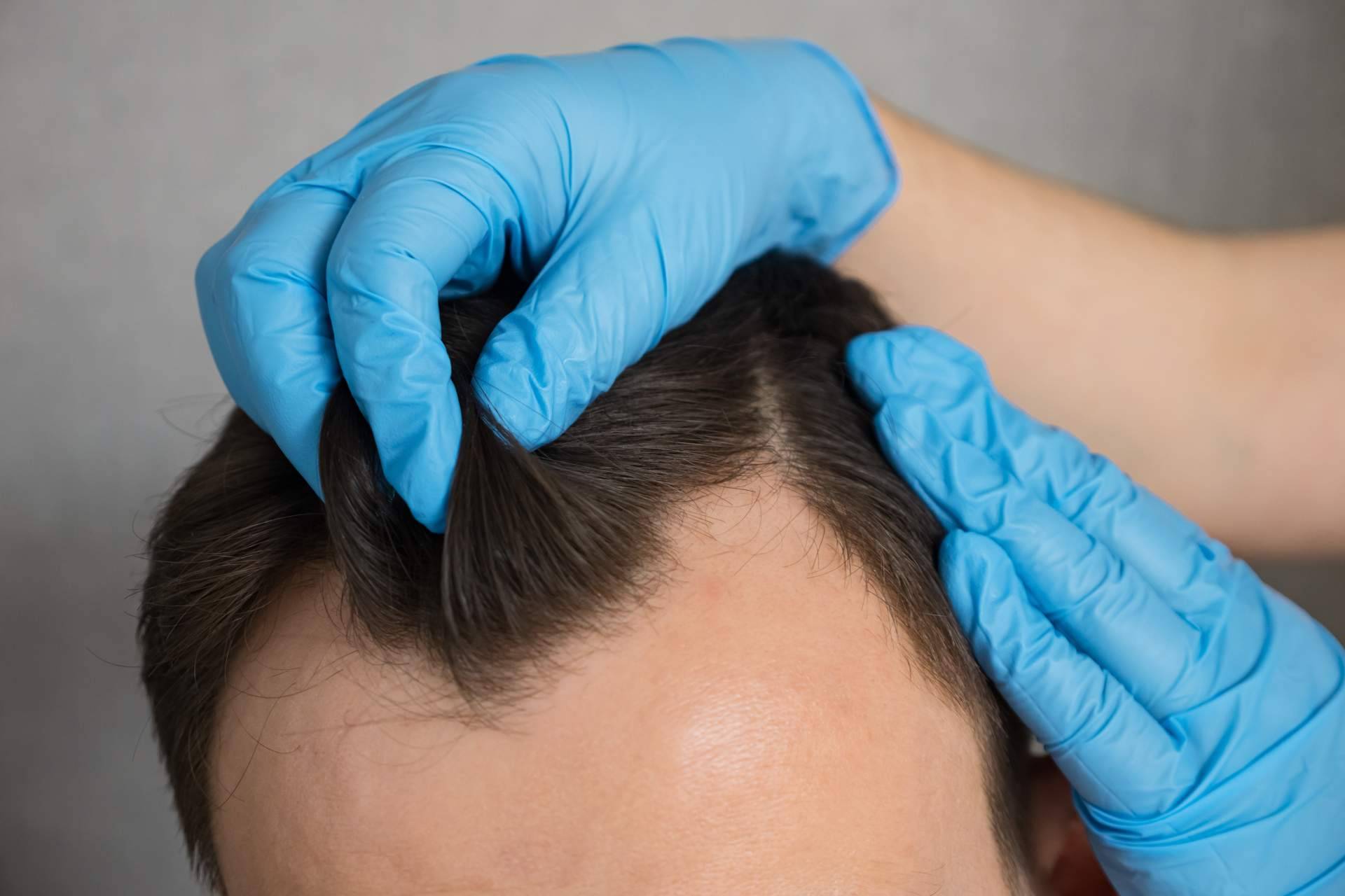 Técnica de trasplante capilar con densidad máxima y efecto natural, últimas plazas en Clínica Capilar Mora
