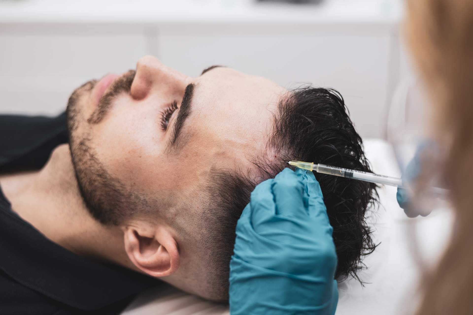 Recuperar el cabello sin pasar por quirófano; la alternativa al trasplante capilar que gana interés