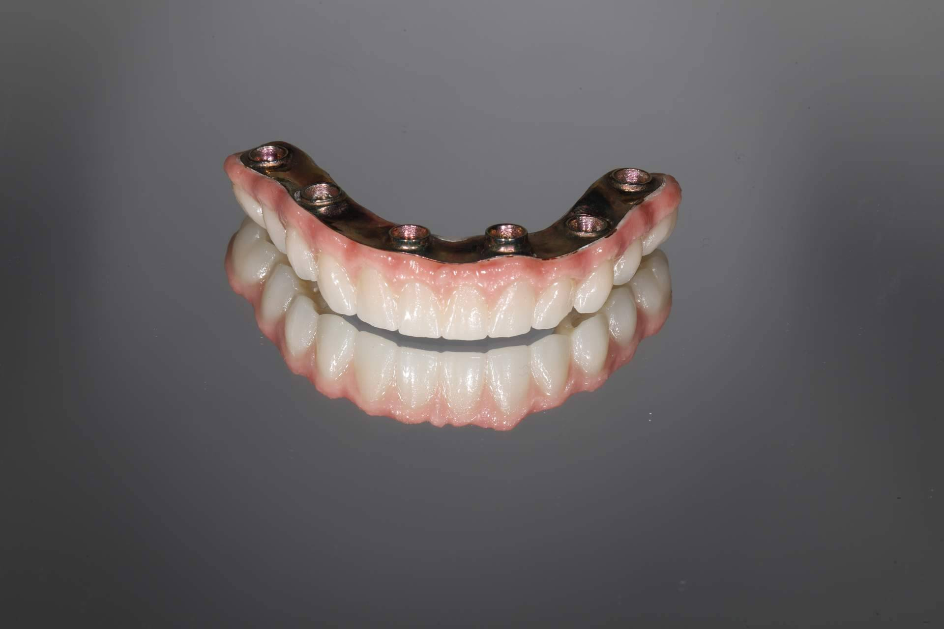 El éxito de los implantes dentales empieza antes de la cirugía, según especialistas
